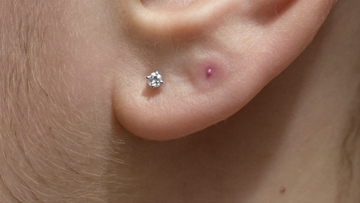 A small pink irritation bump beside a healing ear piercing with a titanium crystal stud — not a keloid